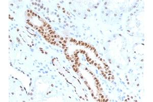 Formalin-fixed, paraffin-embedded human Renal Cell Carcinoma stained with PAX8 Mouse Monoclonal Antibody (PAX8/1491). (PAX8 antibody  (AA 60-261))