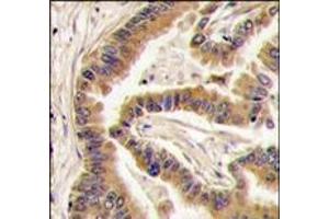 Formalin-fixed and paraffin-embedded human lung carcinoma tissue reacted with CK1a antibody (C-term), which was peroxidase-conjugated to the secondary antibody, followed by DAB staining. (CSNK1A1 antibody  (C-Term))