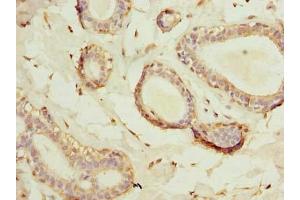 Immunohistochemistry of paraffin-embedded human breast cancer using ABIN7175449 at dilution of 1:100 (HSD17B12 antibody  (AA 40-181))