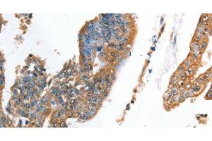 Immunohistochemistry of paraffin-embedded Human colon cancer using AKR1D1 Polyclonal Antibody at dilution of 1:35 (AKR1D1 antibody)