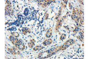 Antibody (5µg/ml) staining of paraffin embedded Human Breast cancer. (ROR1 antibody  (C-Term))