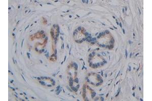 DAB staining on IHC-P;;Samples: Human Pancreatic cancer Tissue