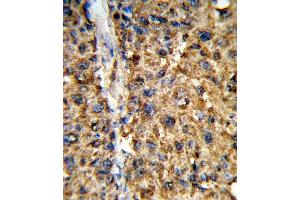 Formalin-fixed and paraffin-embedded human hepatocarcinoma reacted with GSTA2 Antibody (N-term), which was peroxidase-conjugated to the secondary antibody, followed by DAB staining. (GSTa2 antibody  (N-Term))