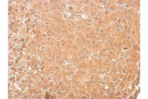 IHC-P Image GAD65 antibody detects GAD2 protein at cytosol on RT2 xenograft by immunohistochemical analysis. (GAD65 antibody  (C-Term))
