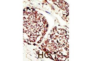 Formalin-fixed and paraffin-embedded human hepatocellular carcinoma tissue reacted with ERBB3 polyclonal antibody  , which was peroxidase-conjugated to the secondary antibody, followed by DAB staining. (ERBB3 antibody  (N-Term))