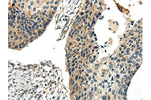 The image on the left is immunohistochemistry of paraffin-embedded Human esophagus cancer tissue using ABIN7190243(CHGB Antibody) at dilution 1/30, on the right is treated with synthetic peptide. (CHGB antibody)