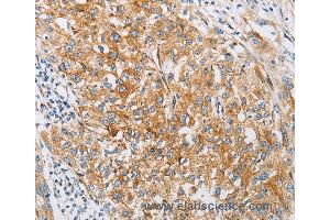 Immunohistochemistry of Human esophagus cancer using IFITM3 Polyclonal Antibody at dilution of 1:25 (IFITM3 antibody)