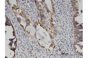 Immunoperoxidase of monoclonal antibody to GLUD2 on formalin-fixed paraffin-embedded human ovarian cancer. (GLUD2 antibody  (AA 1-264))