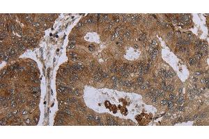 Immunohistochemistry of paraffin-embedded Human colon cancer tissue using FOLH1B Polyclonal Antibody at dilution 1:30