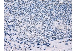 Immunohistochemical staining of paraffin-embedded Adenocarcinoma of colon tissue using anti-SSX2mouse monoclonal antibody.
