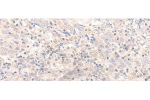 Immunohistochemistry of paraffin-embedded Human cervical cancer tissue using IL26 Polyclonal Antibody at dilution of 1:30(x200) (IL-26 antibody)