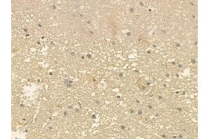 ABIN6257849 and ABIN6275297 at 1/100 staining human glioblastoma by IHC-P. (NXPH3 antibody  (Internal Region))