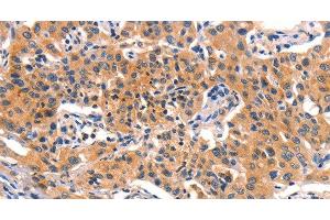 Immunohistochemistry of paraffin-embedded Human lung cancer using AMY2A Polyclonal Antibody at dilution of 1:50 (AMY2A antibody)