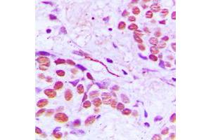 Immunohistochemical analysis of Gamma-tubulin staining in human breast cancer formalin fixed paraffin embedded tissue section. (TUBG1 antibody  (C-Term))
