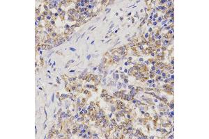 Immunohistochemistry of paraffin-embedded human lung cancer using TNFRSF1B antibody (ABIN6291033) at dilution of 1:200 (40x lens).