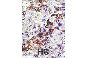 Formalin-fixed and paraffin-embedded human hepatocellular carcinoma tissue reacted with UBE2E3 polyclonal antibody  , which was peroxidase-conjugated to the secondary antibody, followed by AEC staining.