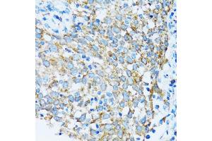 Immunohistochemistry of paraffin-embedded human lung cancer using PRDX3 antibody (ABIN5971574) at dilution of 1/100 (40x lens). (Peroxiredoxin 3 antibody)