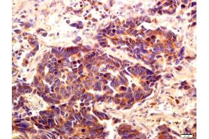 Formalin-fixed and paraffin embedded human lung carcinoma labeled with Anti-PI 3 Kinase Class 3 Polyclonal Antibody, Unconjugated (ABIN754708) at 1:200 followed by conjugation to the secondary antibody and DAB staining (PIK3C3 antibody  (AA 301-400))