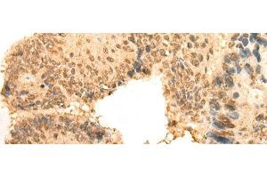 Immunohistochemistry of paraffin-embedded Human colorectal cancer tissue using CEP57 Polyclonal Antibody at dilution of 1:30(x200) (CEP57 antibody)