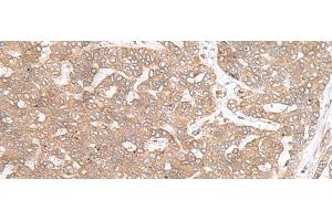 Immunohistochemistry of paraffin-embedded Human liver cancer tissue using PTP4A3 Polyclonal Antibody at dilution of 1:40(x200) (PTP4A3 antibody)