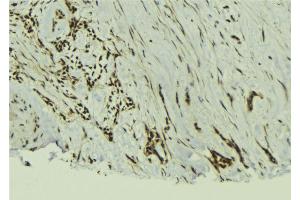 ABIN6273019 at 1/100 staining Human breast cancer tissue by IHC-P. (TAF12 antibody  (N-Term))