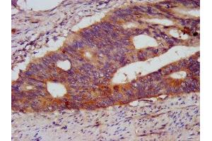 IHC image of ABIN7151045 diluted at 1:500 and staining in paraffin-embedded human colon cancer performed on a Leica BondTM system.