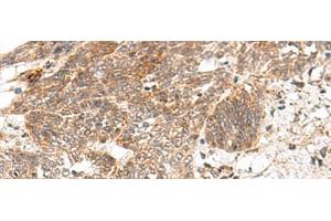 Immunohistochemistry of paraffin-embedded Human esophagus cancer tissue using GRASP Polyclonal Antibody at dilution of 1:150(x200) (Tamalin/GRASP antibody)