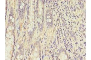 Immunohistochemistry of paraffin-embedded human colon cancer using ABIN7148658 at dilution of 1:100 (CKB antibody  (AA 2-270))