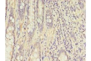 Immunohistochemistry of paraffin-embedded human colon cancer using ABIN7148658 at dilution of 1:100 (CKB antibody  (AA 2-270))