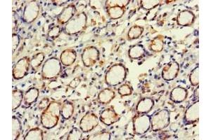 Immunohistochemistry of paraffin-embedded human gastric cancer using ABIN7152269 at dilution of 1:100 (EXD2 antibody  (AA 137-245))