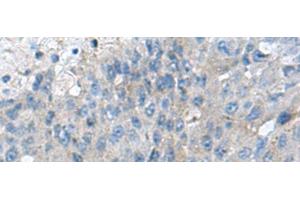 Immunohistochemistry of paraffin-embedded Human liver cancer tissue using KIAA0556 Polyclonal Antibody at dilution of 1:70(x200) (KIAA0556 antibody)