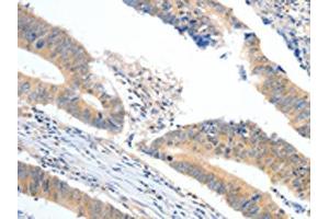 The image on the left is immunohistochemistry of paraffin-embedded Human colon cancer tissue using ABIN7189848(APOB Antibody) at dilution 1/10, on the right is treated with synthetic peptide. (APOB antibody)