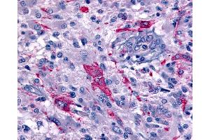Anti-GPR45 antibody IHC of human Brain, Glioblastoma. (GPR45 antibody  (Extracellular Domain))
