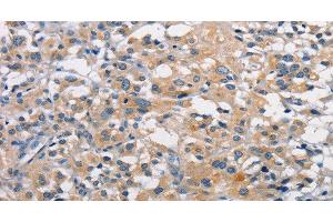 Immunohistochemistry of paraffin-embedded Human thyroid cancer using PKC epsilon Polyclonal Antibody at dilution of 1:50 (PKC epsilon antibody)