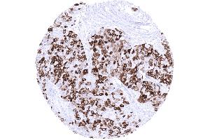 Breast Invasive breast cancer of no special type NST with variable mammaglobin immunostaining in tumor cells mosaic pattern (Recombinant Mammaglobin antibody)