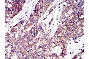 Immunohistochemical analysis of paraffin-embedded ovarian cancer tissues using TWF1 antibody with DAB staining. (TWF1 antibody  (AA 335-384))