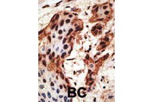 Formalin-fixed and paraffin-embedded human cancer tissue reacted with GJB6 polyclonal antibody  , which was peroxidase-conjugated to the secondary antibody, followed by AEC staining. (GJB6 antibody  (N-Term))