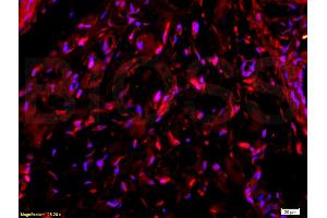 Formalin-fixed and paraffin-embedded human colon carcinoma labeled with Anti-Collagen V Polyclonal Antibody, Unconjugated (ABIN669996) 1:200 followed by conjugation to the secondary PE antibody and DAB staining (Collagen Type V antibody  (AA 1450-1500))