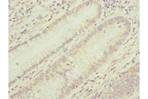 Immunohistochemistry of paraffin-embedded human colon cancer using ABIN7159903 at dilution of 1:100 (TIMM17B antibody  (AA 1-172))