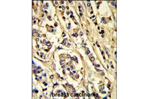 Formalin-fixed and paraffin-embedded human breast carcinoma reacted with VGFR2 Antibody, which was peroxidase-conjugated to the secondary antibody, followed by DAB staining. (VEGFR2/CD309 antibody)