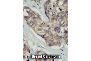 Formalin-fixed and paraffin-embedded human cancer tissue reacted with the primary antibody, which was peroxidase-conjugated to the secondary antibody, followed by DAB staining. (DOK5 antibody  (C-Term))