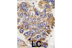 Formalin-fixed and paraffin-embedded human lung carcinoma tissue reacted with GRB2 polyclonal antibody  , which was peroxidase-conjugated to the secondary antibody, followed by DAB staining. (GRB2 antibody  (Tyr209))