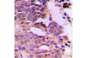 Immunohistochemical analysis of SIAH1/2 staining in human breast cancer formalin fixed paraffin embedded tissue section. (SIAH1/2 antibody  (Center))
