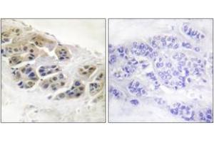 Immunohistochemistry analysis of paraffin-embedded human breast carcinoma tissue, using Mammaglobin Antibody.