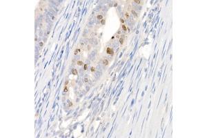 Immunohistochemistry of paraffin-embedded human colon carcinoma using Survivin Rabbit pAb (ABIN6132229, ABIN6137562, ABIN6137563 and ABIN6218613) at dilution of 1:100 (40x lens). (Survivin antibody  (AA 1-142))