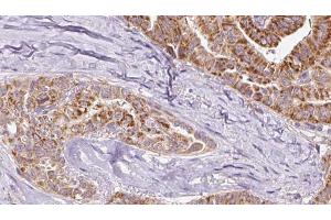 ABIN6267080 at 1/100 staining Human thyroid cancer tissue by IHC-P. (Connexin 43/GJA1 antibody  (pTyr265))