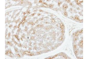 IHC-P Image Immunohistochemical analysis of paraffin-embedded human breast cancer, using ADPGK, antibody at 1:250 dilution. (ADPGK antibody)