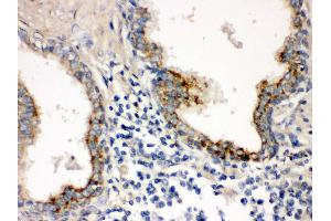 IHC(P): Human Prostatic Cancer Tissue (PTP4A2 antibody  (N-Term))