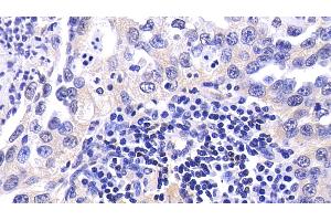 Detection of CASP9 in Human Lung cancer Tissue using Polyclonal Antibody to Caspase 9 (CASP9) (Caspase 9 antibody  (AA 331-416))
