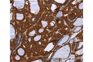 Immunohistochemistry of Human liver cancer using PPP2R3C Polyclonal Antibody at dilution of 1:30 (PPP2R3C antibody)